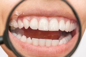 The Power of a Smile Makeover